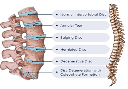 Back-Pain